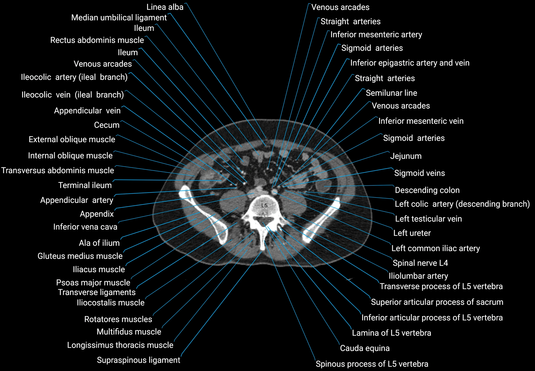 CT male pelvis axial cross sectional anatomy labelled radiology image -00125.webp
